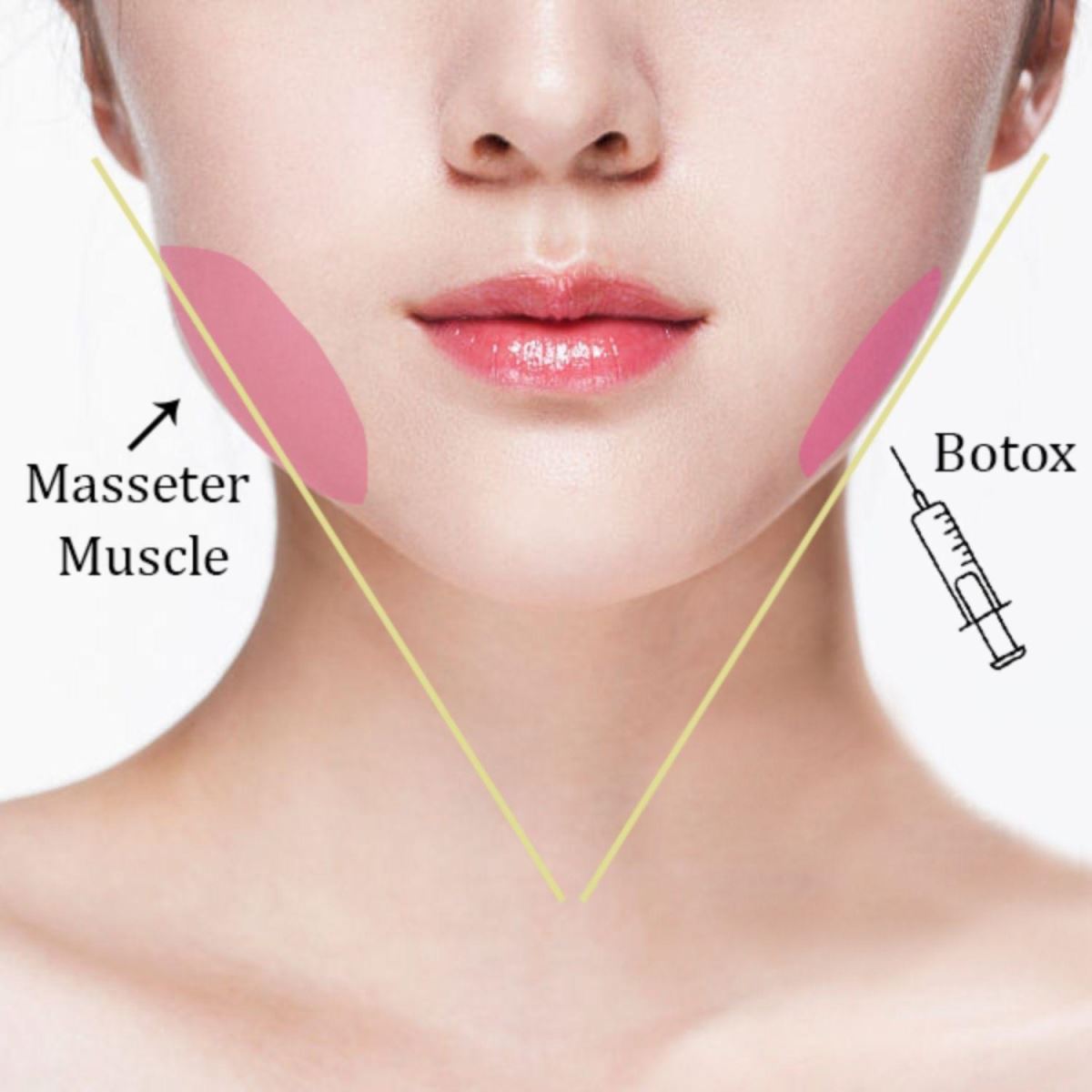 Tiêm Botox Bao Lâu Có Hiệu Quả? Khám Phá Từng Giai Đoạn