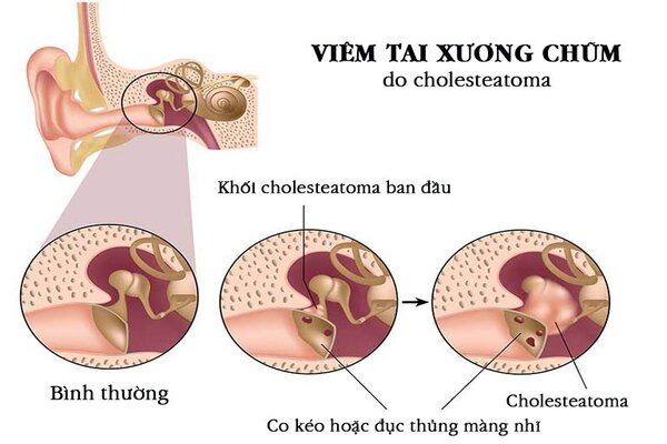 Viêm tai xương chũm