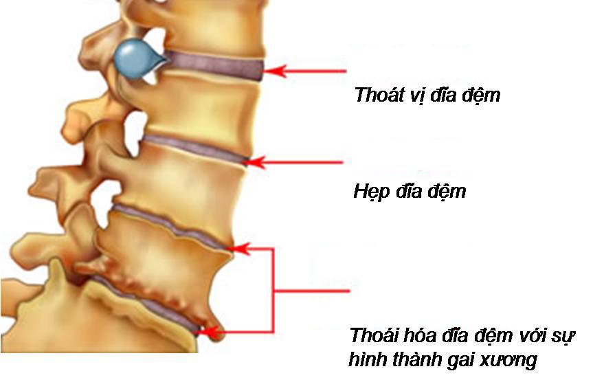 Nguyên nhân gây thoát vị đĩa đệm