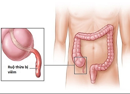 Viêm ruột thừa Hãy để ý 5 triệu chứng này - và đến bác sĩ nếu thấy chúng kèm theo đau bụng.