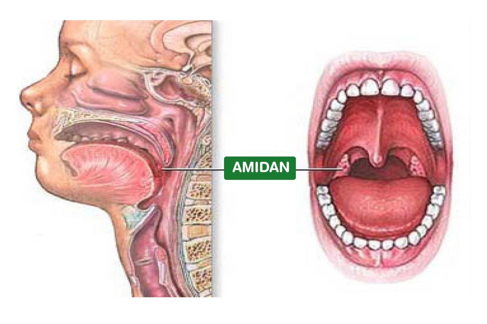 viêm amidan bảo sơn