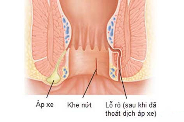 ÁP XE HẬU MÔN : Những điều cần biết & Cách điều trị Bệnh !!