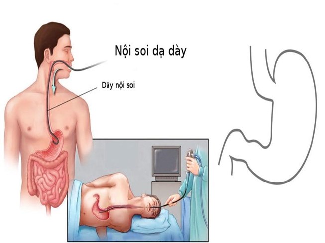 Nội soi là gì? Quy trình, lợi ích và các phương pháp nội soi phổ biến