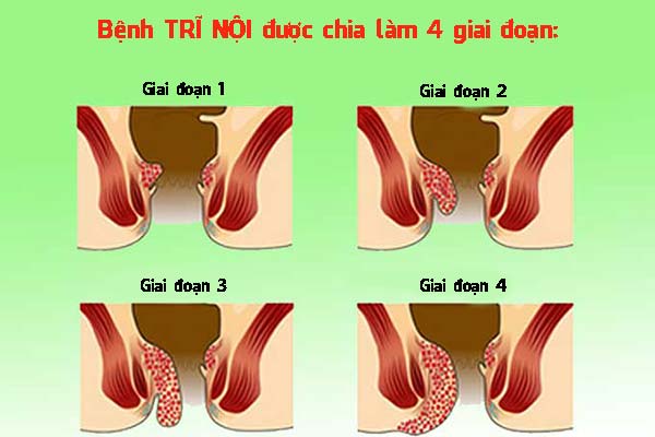 Các giai đoạn của bệnh trĩ nội