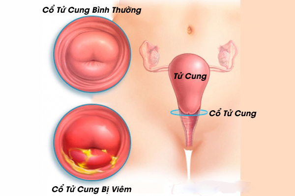 Viêm cổ tử cung: Nguyên nhân, triệu chứng và cách phòng ngừa hiệu quả