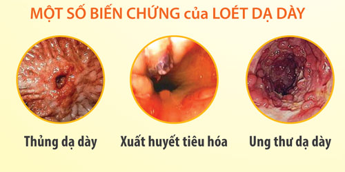 Biến chứng nguy hiểm của viêm loét dạ dày 2