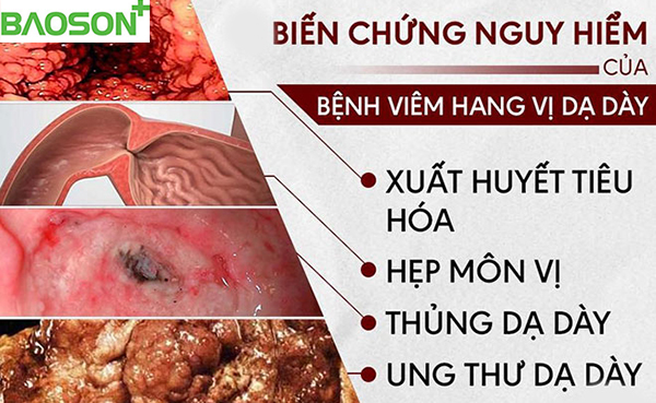 Biến chứng nguy hiểm của bệnh viêm hang vị dạ dày