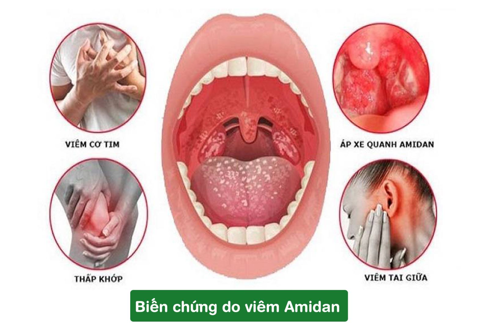 biến chứng viêm amidan