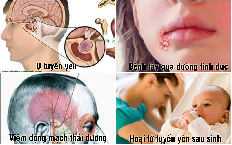 Viêm Tuyến Yên: Nguyên Nhân, Triệu Chứng và Phương Pháp Điều Trị Hiệu Quả