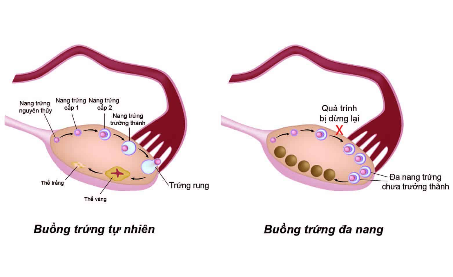 đa nang buồn trứng