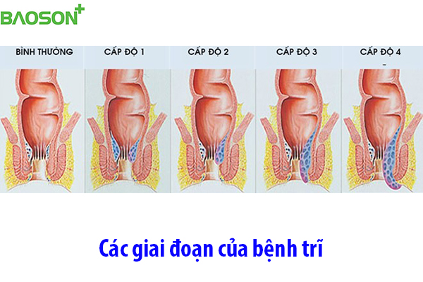 Các giai đoạn của bệnh trĩ