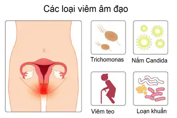 các loại viêm âm đạo 