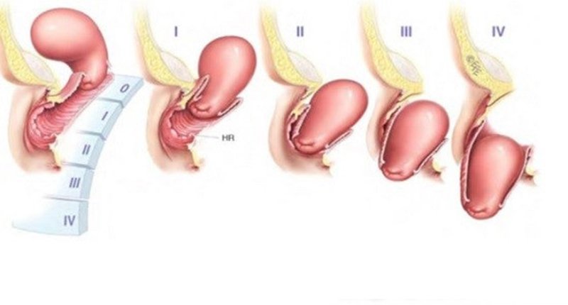 cấp độ sa cổ tử cung 