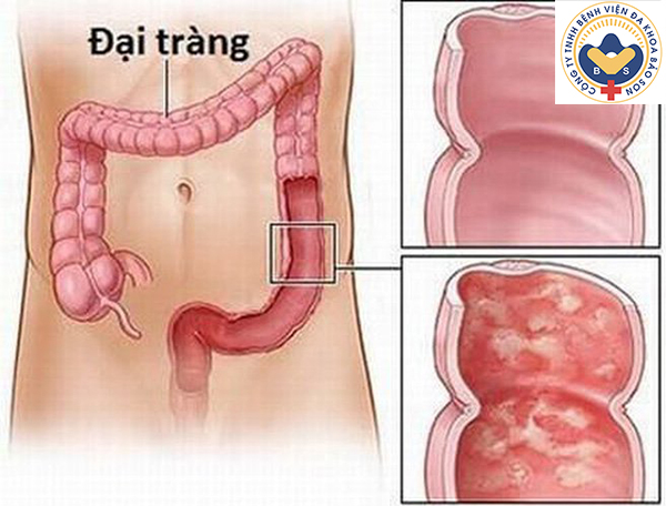 Đại tràng co thắt