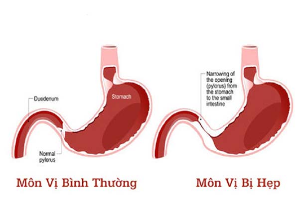 Hội chứng hẹp môn vị: Triệu chứng, nguyên nhân và các phương pháp điều trị hiệu quả