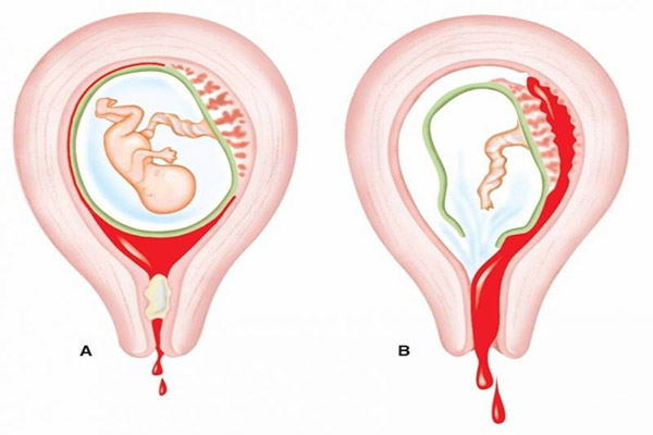 Sót nhau thai có triệu chứng gì? Nguyên nhân và cách xử lý an toàn