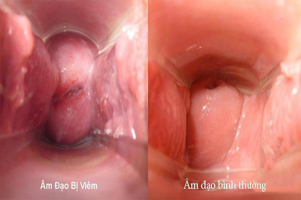 hình ảnh viêm âm đạo