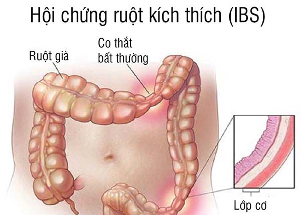 Các câu hỏi thường gặp về hội chứng ruột kích thích