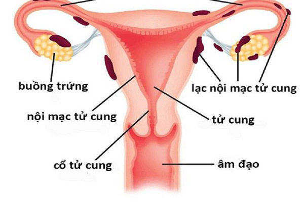 lạc nội mạc tử cung 