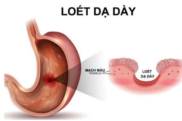 5 dấu hiệu cảnh báo viêm loét dạ dày