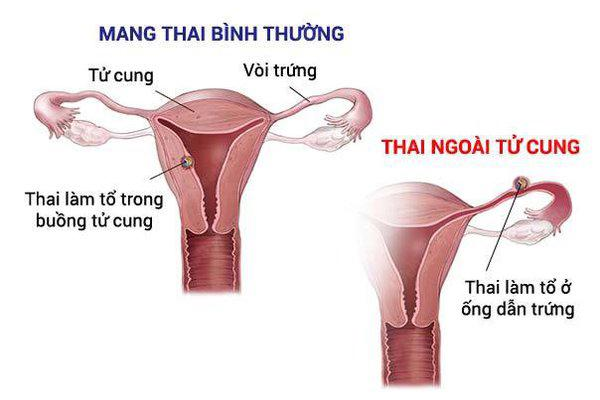 dấu hiệu đau bụng dưới khi mang thai - thai ngoài tử cung 