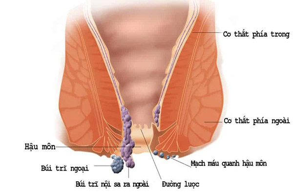 Mẹ bầu bị trĩ ngoại có sinh thường được không? Những điều cần biết