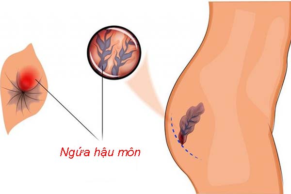 Ngứa Hậu Môn Là Biểu Hiện Của Bệnh Gì? Nguyên Nhân Và Cách Khắc Phục Hiệu Quả