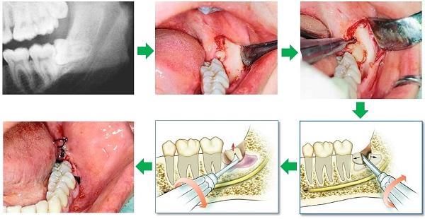 Biến chứng nguy hiểm của răng khôn mọc lệch 2