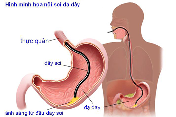 Nội soi dạ dày 