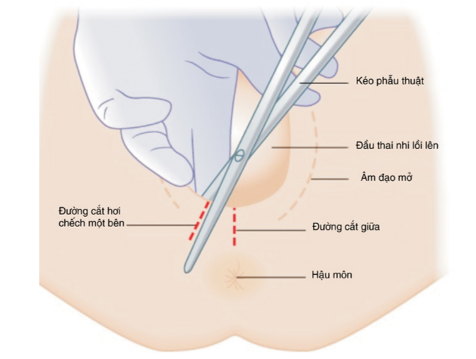 thủ thuật rạch tầng sinh môn