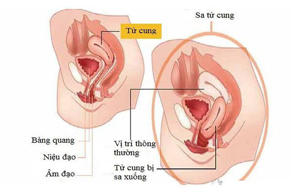 nguyên nhân và dấu hiệu của sa tử cung