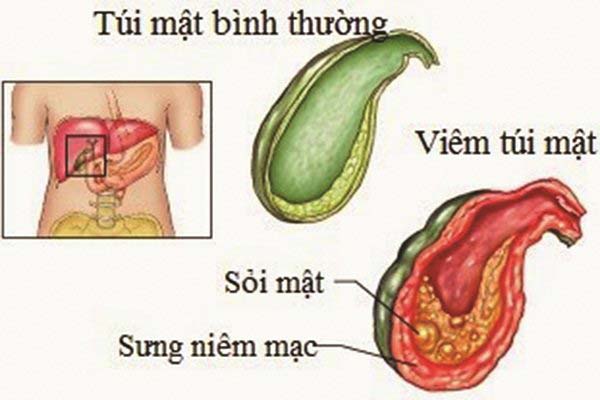 Hình ảnh minh họa sỏi mật