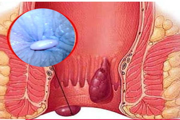 4. Các phương pháp điều trị trĩ ngoại tắc mạch