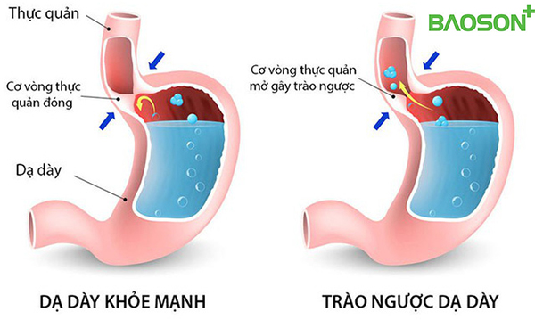 4. Tránh các yếu tố kích thích