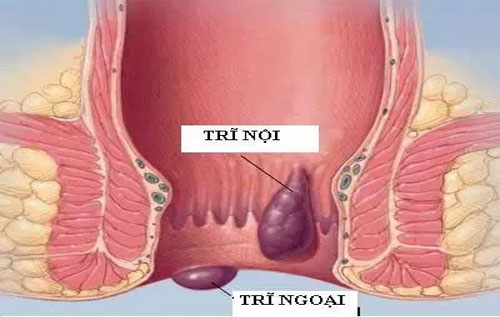 Dấu hiệu của bệnh trĩ 3