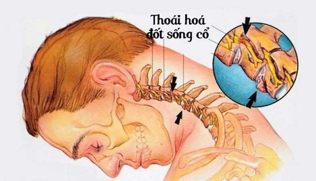 Dấu hiệu bệnh thoái hóa đốt sống cổ 1