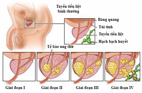 Tại sao nam giới cần sàng lọc ung thư tuyến tiền liệt?