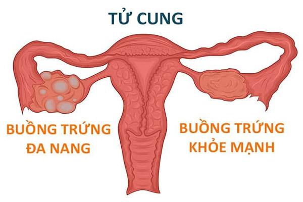 hiện tượng u nang buồng trứng