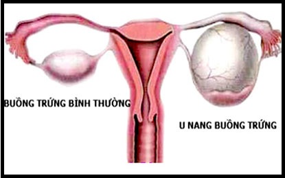 U nang buồng trứng