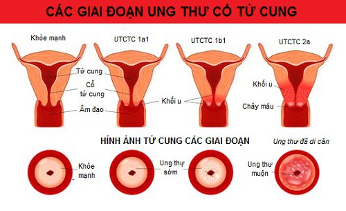 các giai đoạn ung thư cổ tử cung 