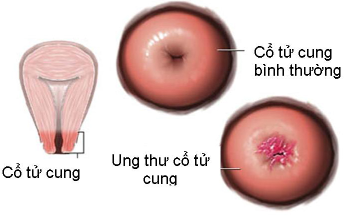 Ung thư cổ tử cung