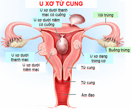 Các vị trí của U xơ trong tử cung