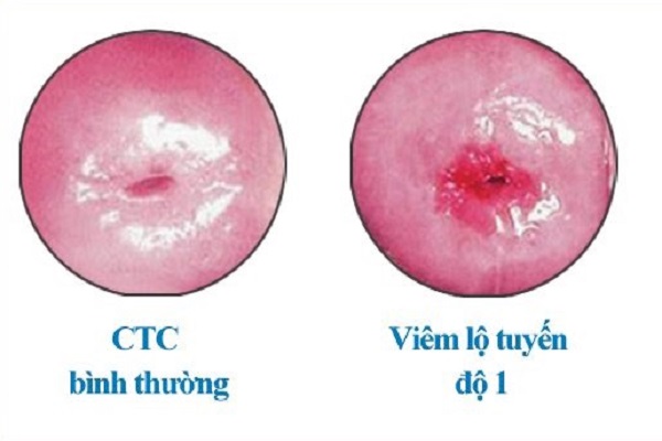 Viêm lộ tuyến 1cm: Nguyên nhân, triệu chứng và cách điều trị