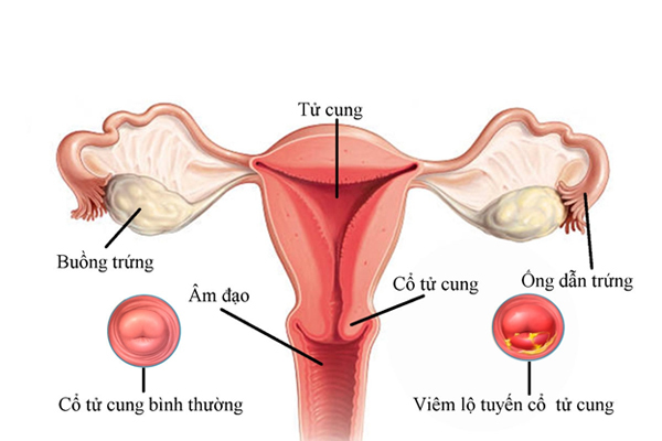 viêm lộ tuyến cổ tử cung