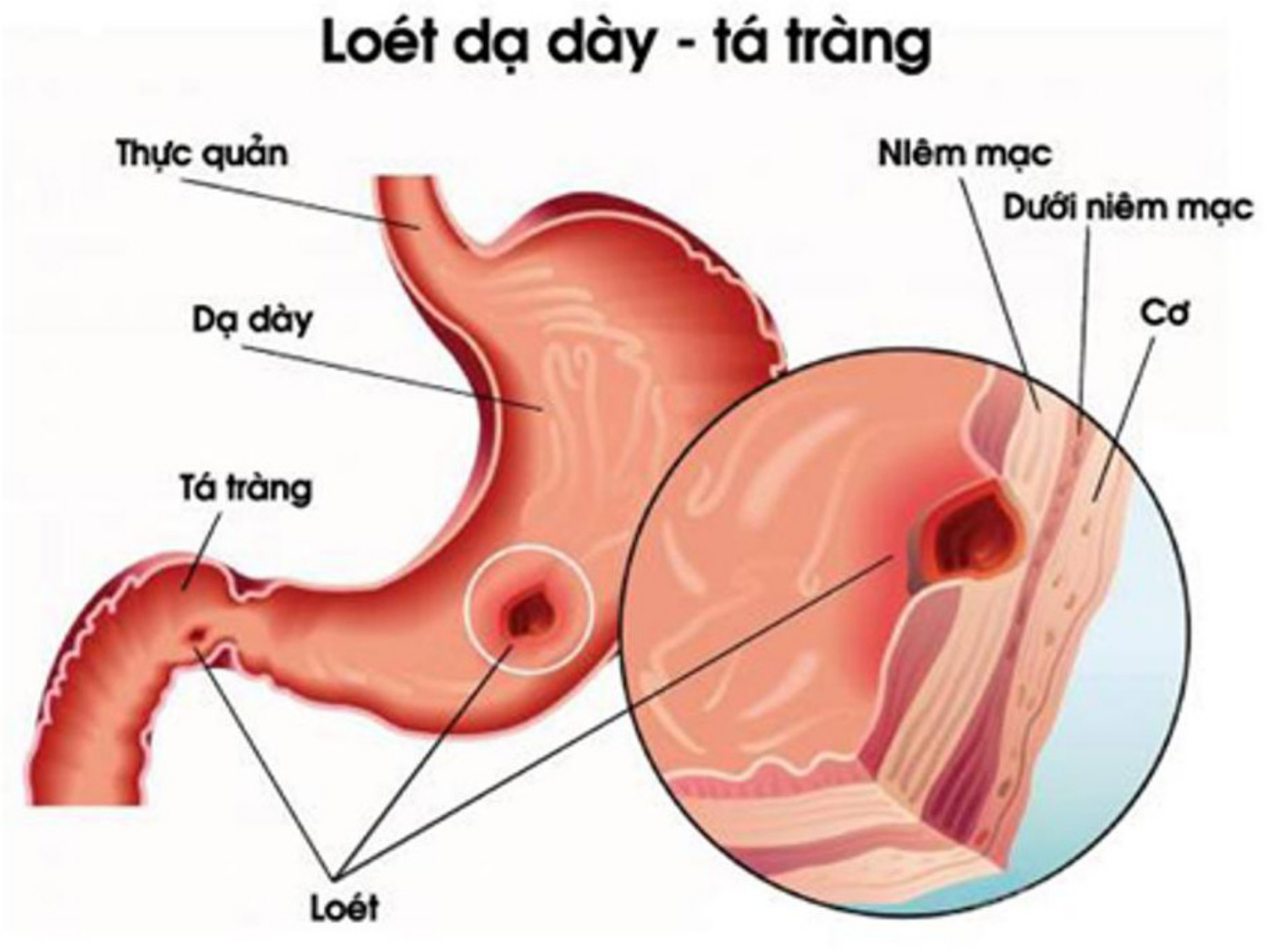 Viêm loét dạ dày nguy hiểm như thế nào 2