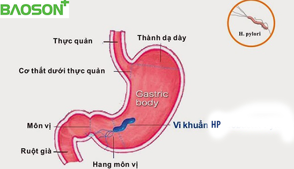 Viêm hang vị dạ dày