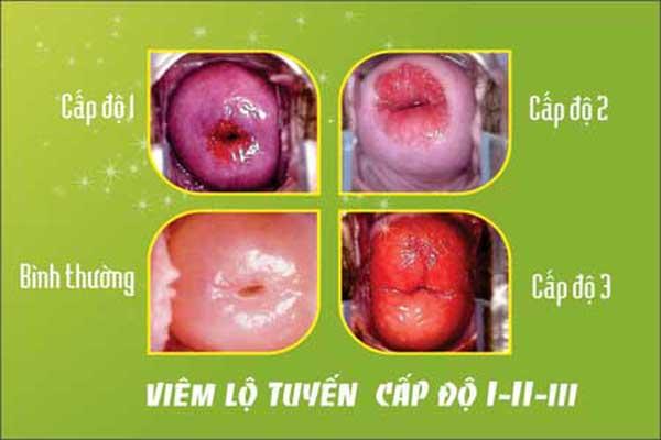 viêm lộ tuyến cổ tử cung cấp độ 1