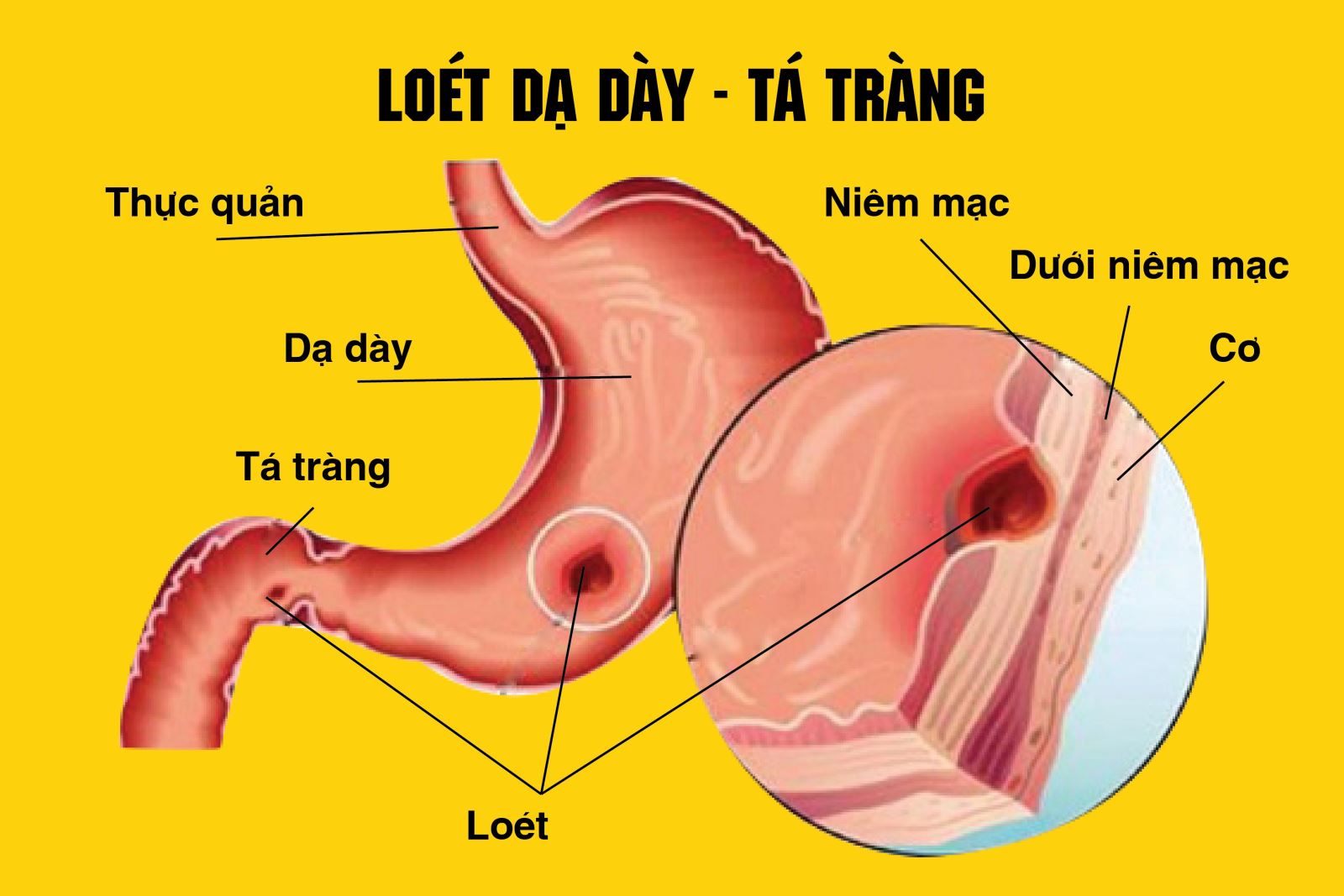 viêm loét dạ dày