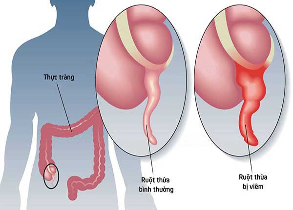 3. Phẫu Thuật Điều Trị Viêm Ruột Thừa