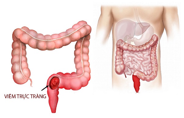 viêm trực tràng bảo sơn